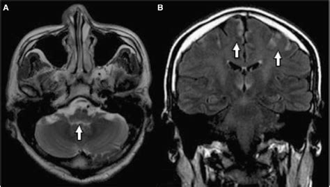 Atypical MRI findings in Wernicke encephalopathy-Axial T2-weighted ...