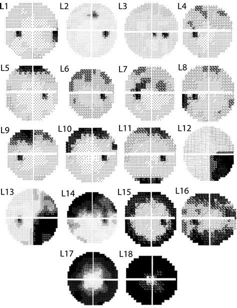 Machine-Identified Patterns of Visual Field Loss and an Association with Rapid Progression in ...