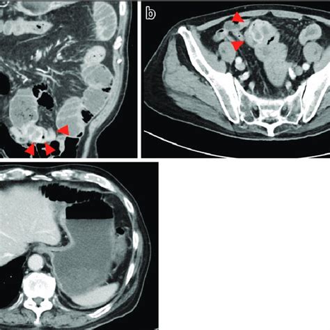 Contrast-enhanced abdominal CT at diagnosis showed a mass of 5.0 cm in ...