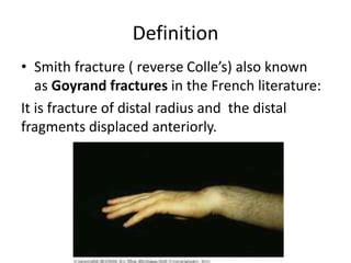 Reverse Colles Fracture