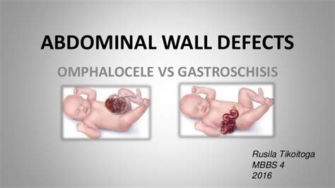 Omphalocele vs gastroschisis