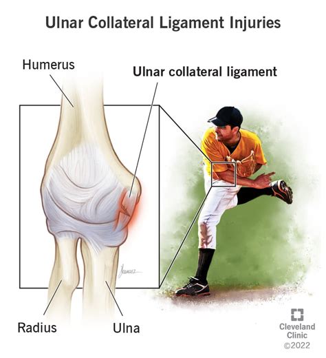 Ulnar Collateral Ligament (UCL) Injuries: Types & Symptoms