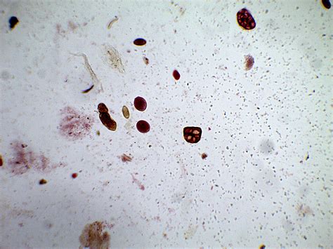 Balantidium Coli Cyst Form