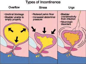 Define on Female Incontinence - Assignment Point