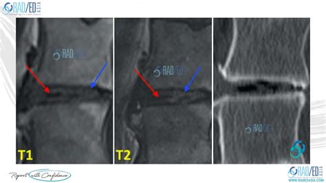 DISCITIS MIMICS: VACUUM PHENOMENON - GAS IN THE DISC (VIDEO) - Radedasia