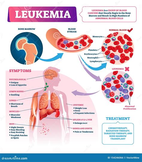 Leukemia Vector Illustration. Labeled Educational Blood Cancer Infographic Stock Vector ...