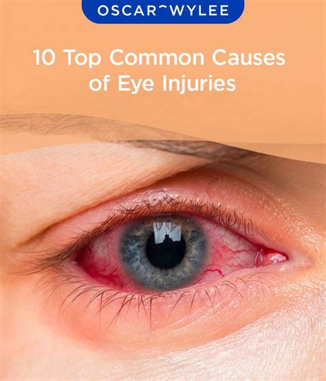 10 Top Common Causes of Eye Injuries