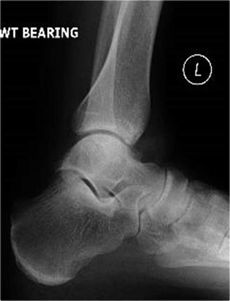 Mid-term follow-up of talar dome resurfacing surgery using the HemiCAP ...