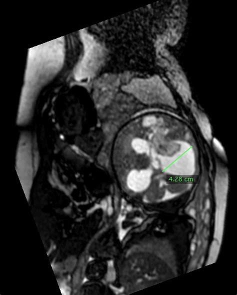 Germinal matrix hemorrhage causes, symptoms, diagnosis, treatment & prognosis