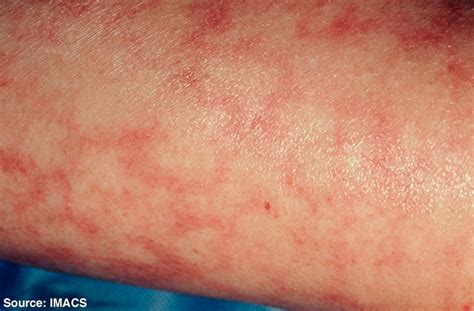 Healthoollivedo reticularis pictures | Healthool