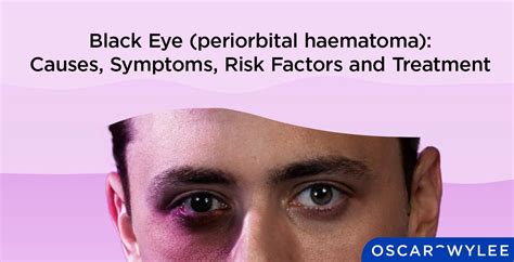 Black Eye (periorbital haematoma): Causes, Symptoms, Risk Factor and Treatment