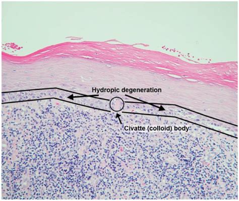 Oral lichen planus high-power H&E photomicrograph (200×). Figure 2.... | Download Scientific Diagram