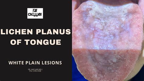 Lichen Planus On Tongue