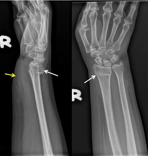 Colles fracture – Radiology Cases