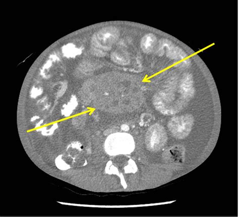 Celiac disease CT scan - wikidoc