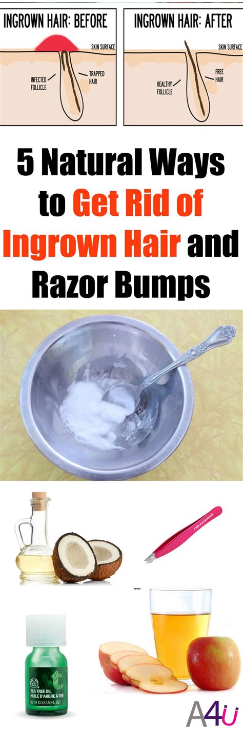 Pin by Jeanne Esposito on Health: Misc | Ingrown hair, Ingrown hair ...