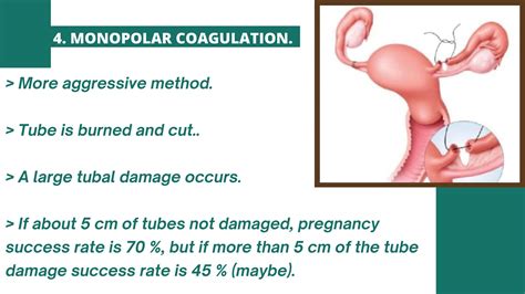 Tubal Reversal