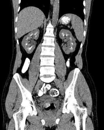 Medullary nephrocalcinosis | Radiology Case | Radiopaedia.org