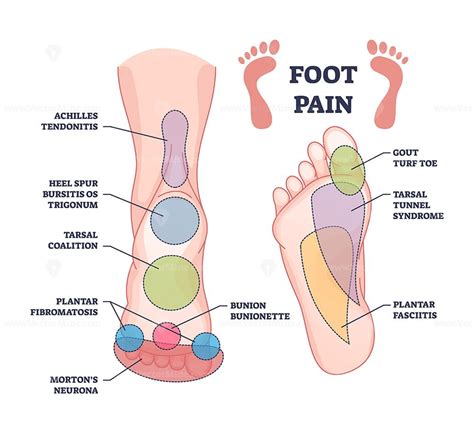 Foot pain causes from zones diagnosis and painful spots areas outline ...