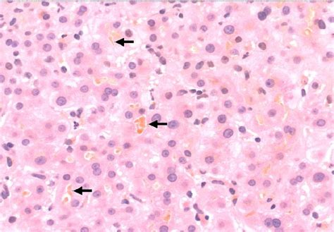 Diagnosis and Management of Cholestatic Liver Disease - Clinical Gastroenterology and Hepatology