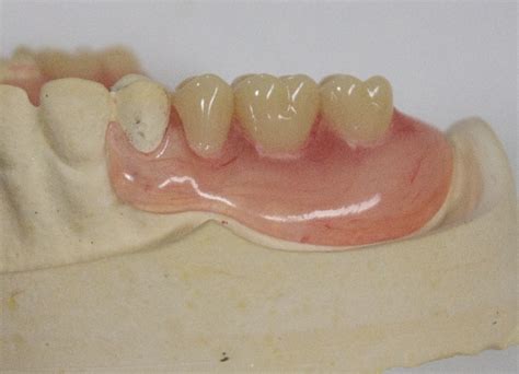 Dentures: cost in the UK privately & NHS, types, alternatives