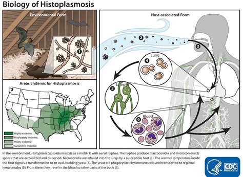 Histoplasmosis - Causes, Symptoms, Diagnosis, Prognosis, Treatment