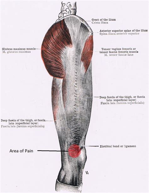 Iliotibial Band Hip Pain