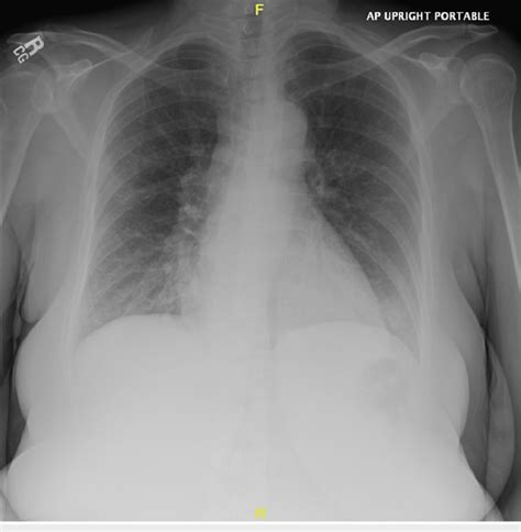 A/P upright chest X-ray: normal cardiomediastinal borders in size and... | Download Scientific ...