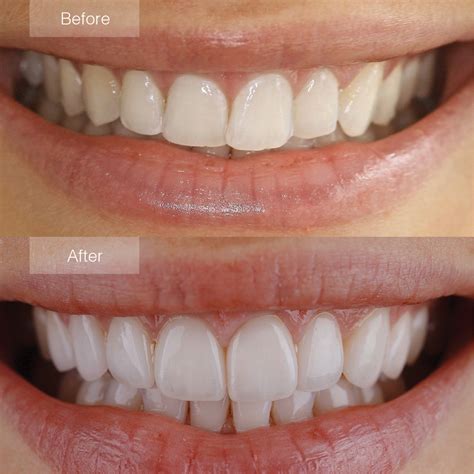 Porcelain Veneers Before and After - The Dental Room