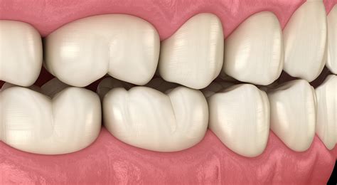 Occlusal Adjustment - Sparacino Periodontics