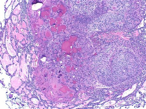 Adenomatoid odontogenic tumor histology demonstrating duct-like ...