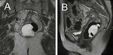 MRI in rectal cancer, T-stage and mesorectal fascia (MRF)... | Download ...