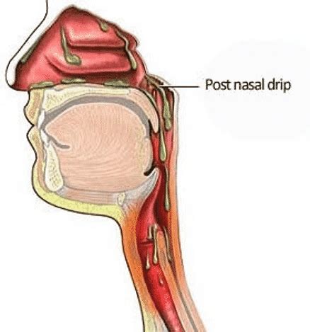 Post Nasal Drip | GNO Snoring & Sinus