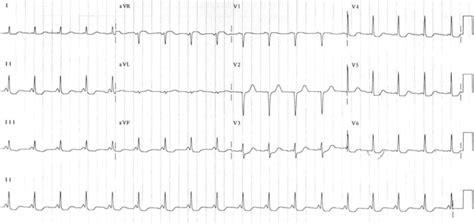 PR Interval • LITFL • ECG Library Basics