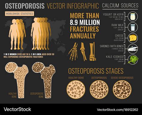 Osteoporosis Infographic Poster Royalty Free Vector Image