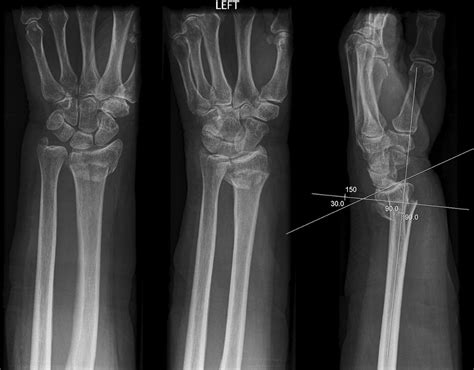 Colles Fracture X Ray