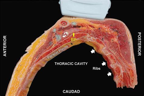 Ultrasound-Guided Supraclavicular Brachial Plexus Block | Anesthesia Key