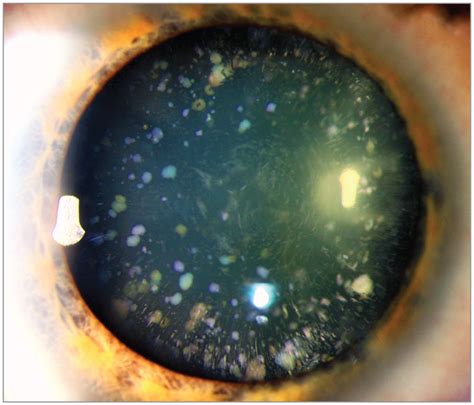 This case report describes a 20-year-old woman with atypical cerulean ...