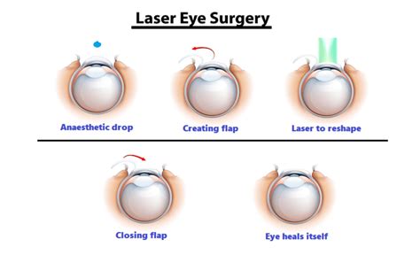 LASIK Refractive Laser Correction | Melbourne | Australia | City Eye ...