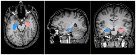 Cerebral MRI depicting manual segmentation of hippocampus. Figure shows... | Download Scientific ...