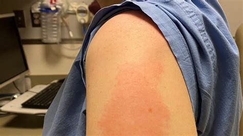 COVID study: 'Moderna arm' vaccine rash no worse with second shot