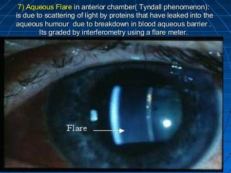 Uveitis Eye presentation- Darayus