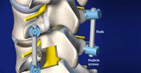 Nashville, TN - Transforaminal Lumbar Interbody Fusion (TLIF) - Dube ...