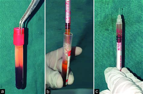 Preparation of injectable platelet rich fibrin (a) Post centrifugation.... | Download Scientific ...