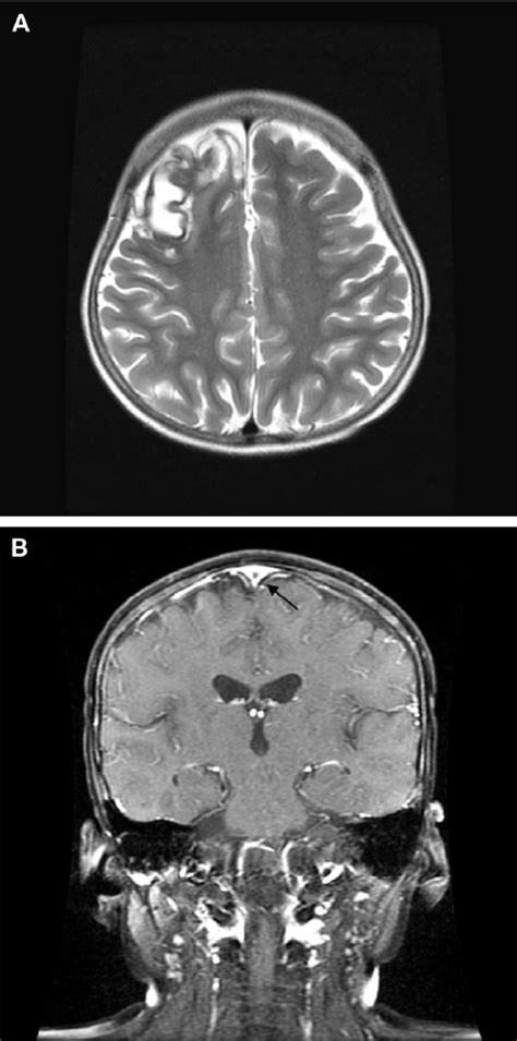 Three months after superior sagittal sinus thrombosis episode. (A)... | Download Scientific Diagram