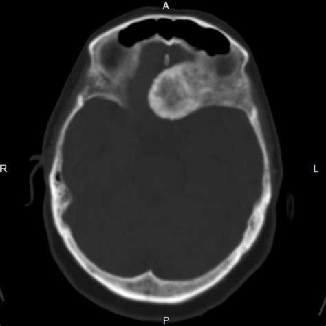 Osteoma of orbital roof | Radiology Case | Radiopaedia.org | Radiology ...