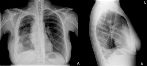 Chest X-ray, on posterior-anterior (A) and lateral (B) views ...