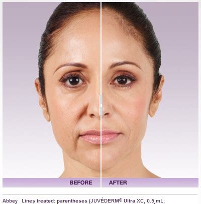 Juvederm Filler – Cost, Results, Risks, Side Effects | Beverly Hills