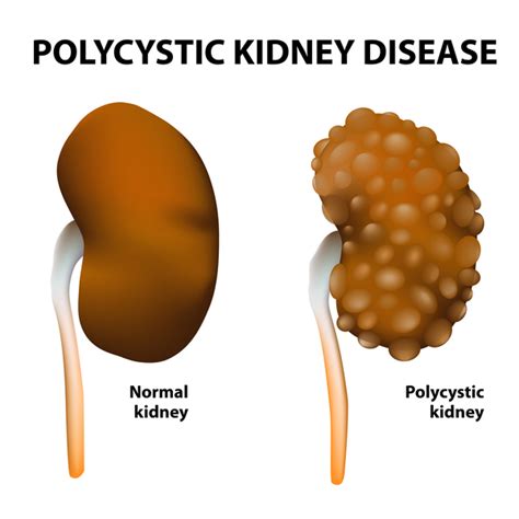 Polycystic kidney disease: MedlinePlus Genetics