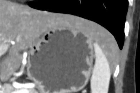 Beaver tail liver as seen on a coronal CT (normal variant) | Radiology, Normal, Beaver tails